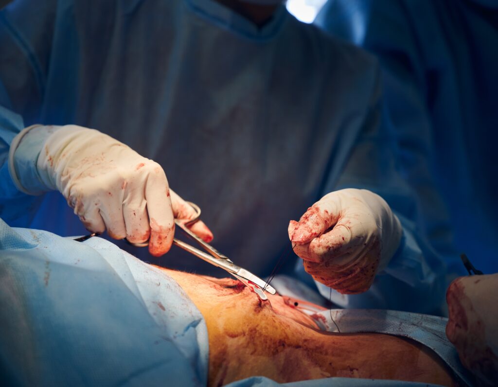 Doctor stitching up wound after abdominoplasty surgery.