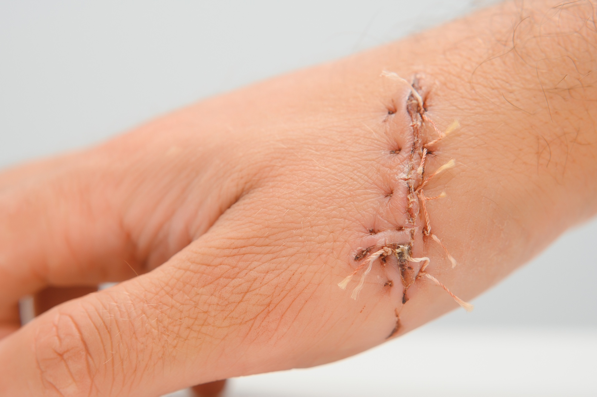 wound hand, suturing the wound. The type of cut after surgery.